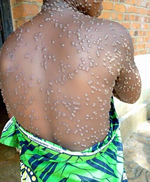 Sud-Kivu : à Mwenga, 25 cas suspects de Mpox signalés dans l’aire de santé de Kitopo