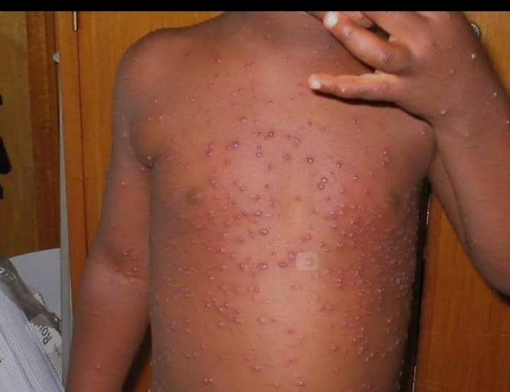 Sud-Kivu : plus de 2 000 cas de rougeole et de choléra enregistrés à Shabunda, la société civile appelle à une riposte urgente