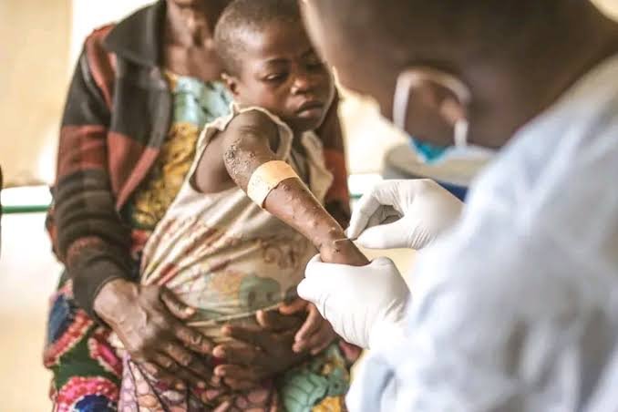 Sud-Kivu : face à la recrudescence du choléra à Mulungu, les autorités sanitaires déclenchent une riposte d'urgence